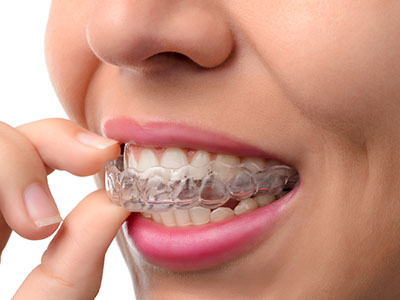 invisalign vs consumer