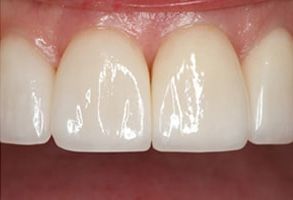 Michael B. Schwarz, DMD | Dentures, Veneers and Implant Restorations