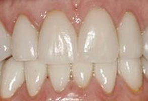 Michael B. Schwarz, DMD | Crowns  amp  Caps, Invisalign reg  and Dental Cleanings