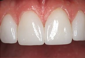 Michael B. Schwarz, DMD | Teeth Bleaching and Whitening, Dentures and Veneers