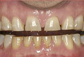 Michael B. Schwarz, DMD | Crowns  amp  Caps, Dentures and Dental Cleanings