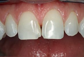 Michael B. Schwarz, DMD | Crowns  amp  Caps, Dental Fillings and Dental Bridges
